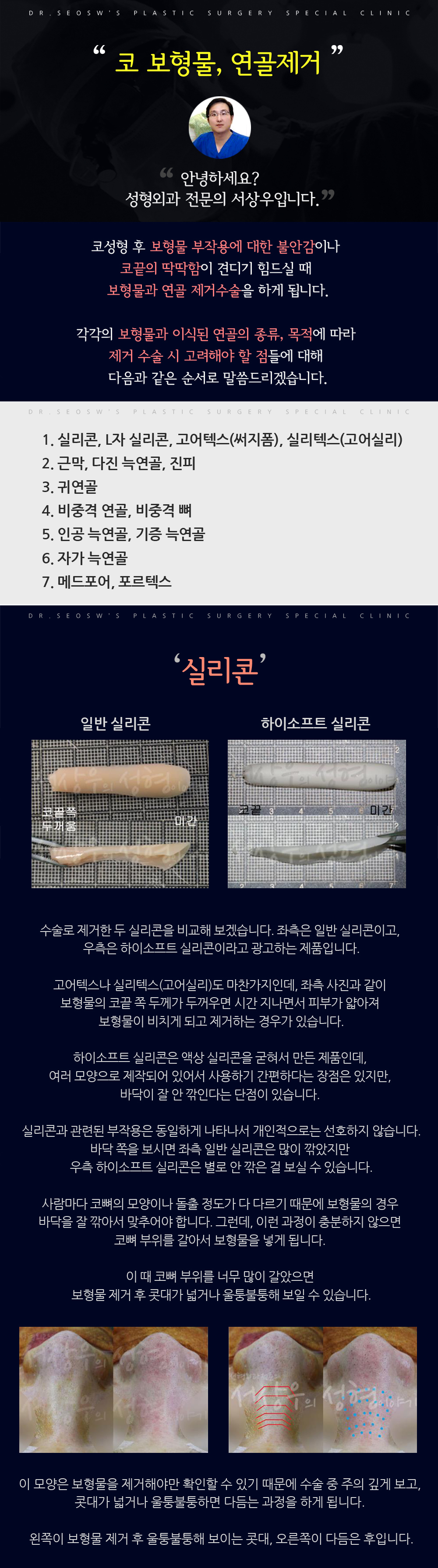 코 보형물 연골 제거_실리콘 제거